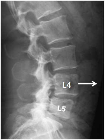 fig3-roh-46yo-female-pharmacist-decompression-pre-op-lateral-ray