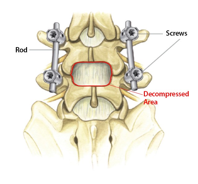 spinal-fusion-diagram