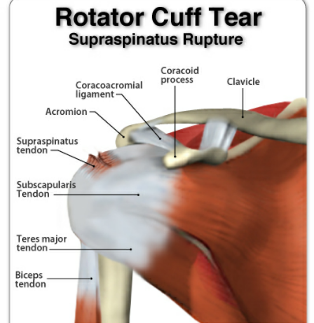 Diagram Of Rotator Cuff Torn Rotator Cuff Surgery Needed My Xxx Hot Girl 