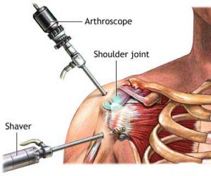 Post Surgery Update w/ Rehab Protocol .PDF