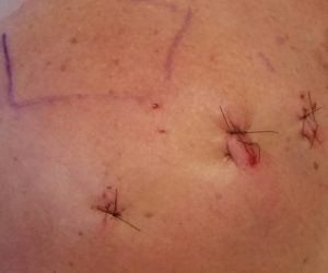 6 Months Post Shoulder Surgery Update! (w/video's)