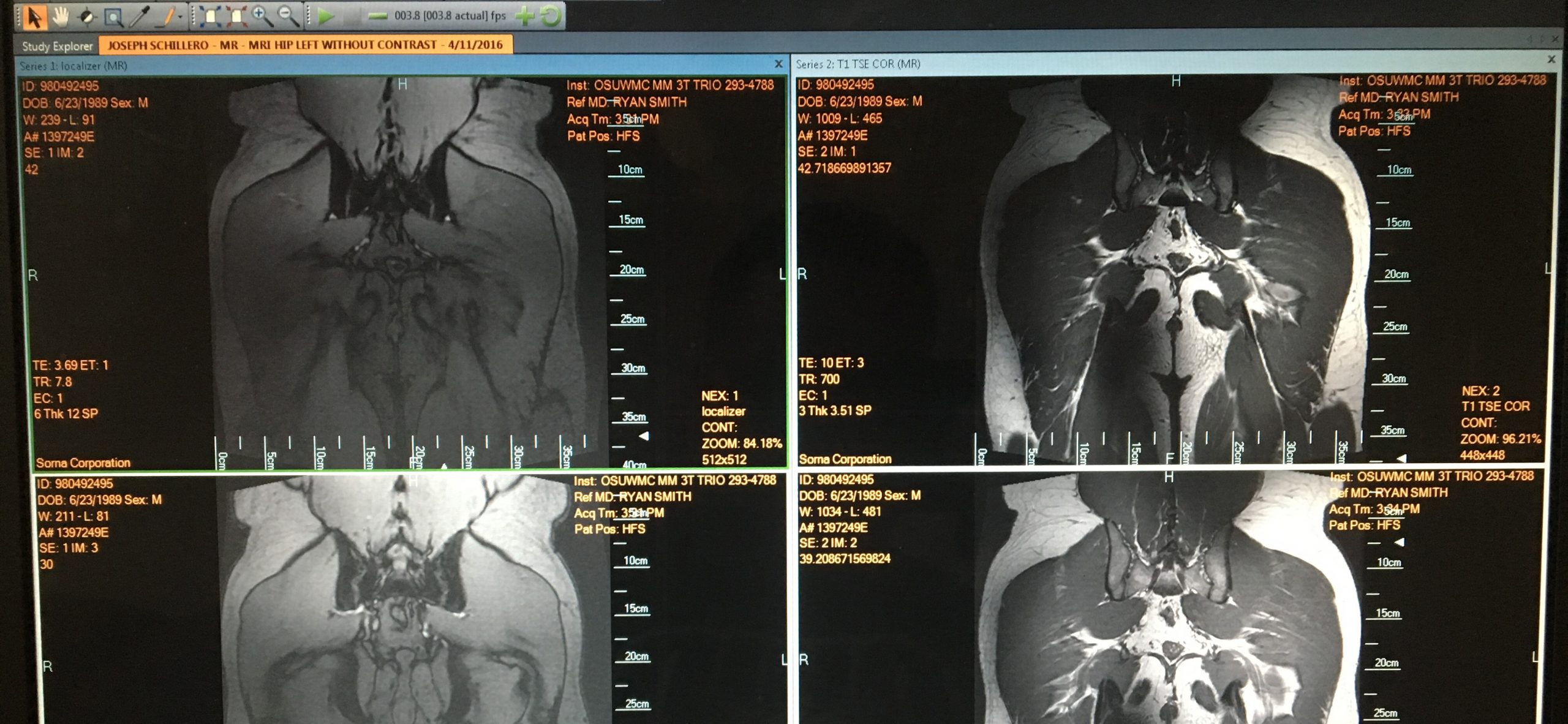 Appointment with Hip Specialist / Future Hip Replacement? / & the Return to Competing Raw