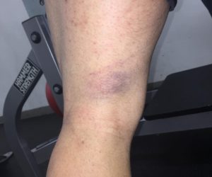 How I was able to hurt myself during vacation ... while training?!