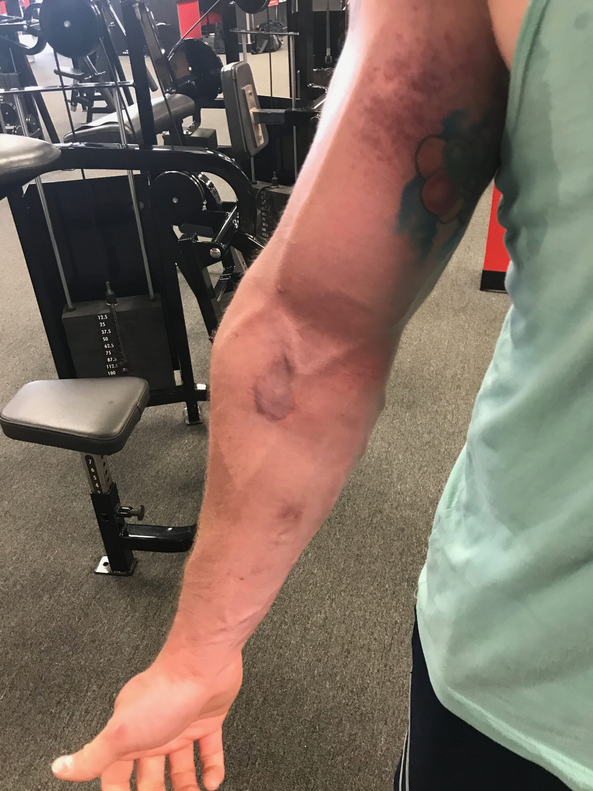 Strongman Patient (Biceps Repair)