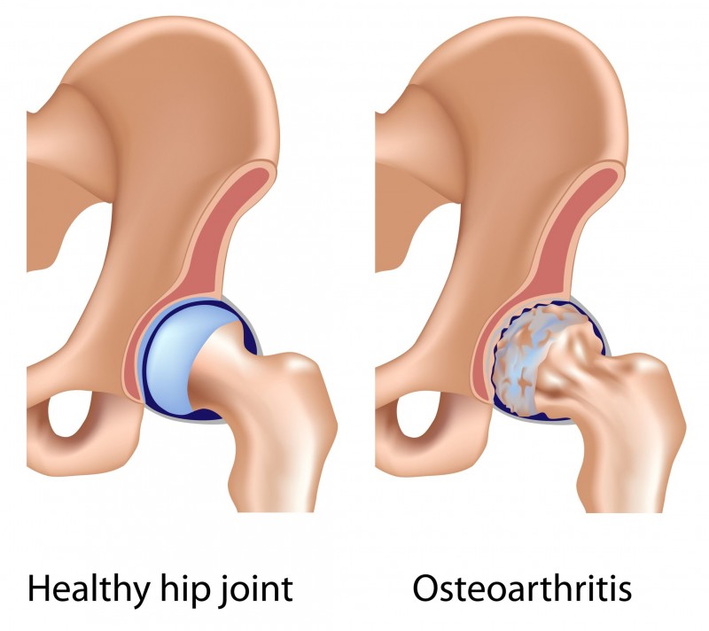 11122404 - osteoarthritis of hip joint, eps8