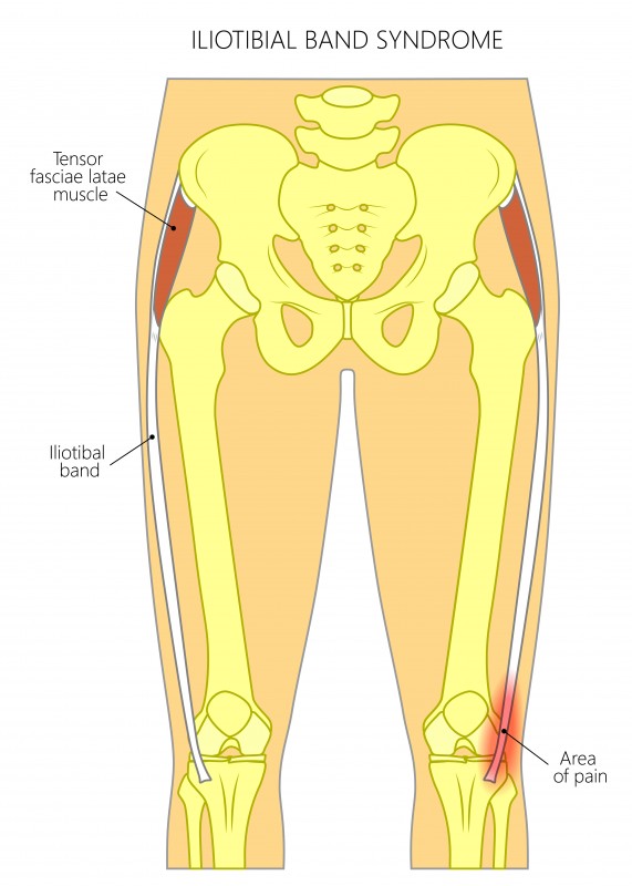 Pain in the hip joint_iliotibial band syndrome