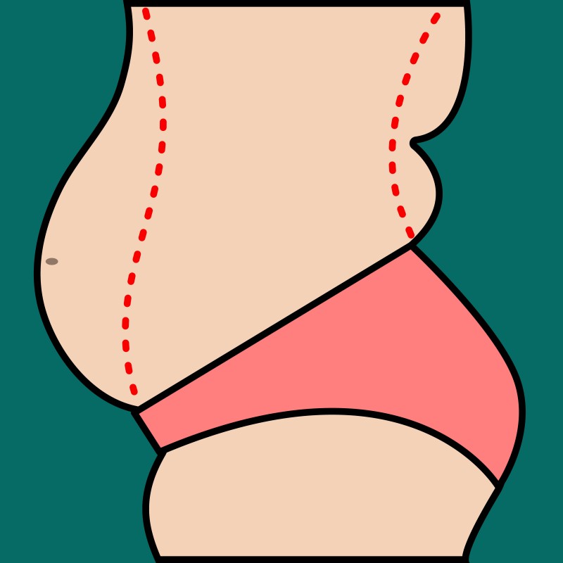 Liposuction of abdomen