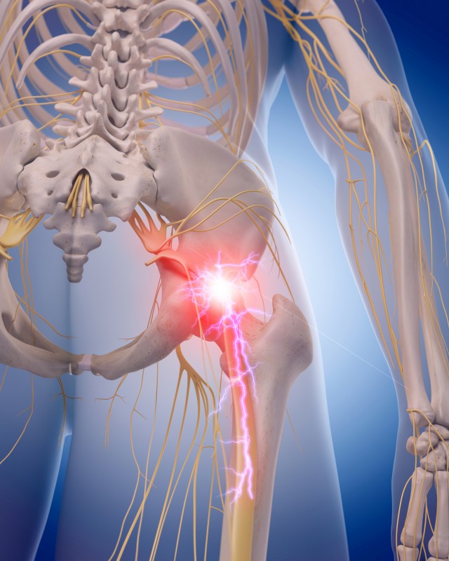 medically accurate illustration of a painful sciatic nerve