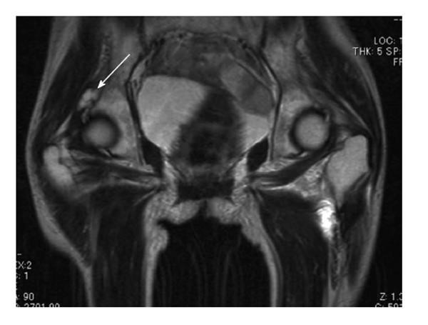 femur cyst