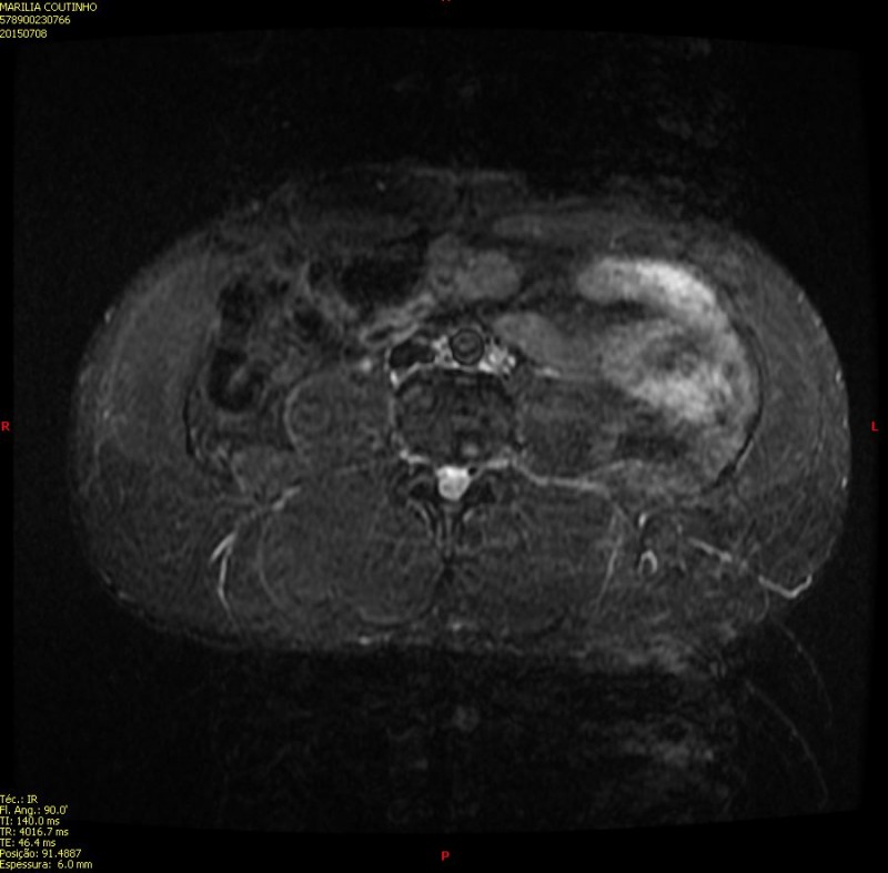 July 2015 rectus abdominalis tear