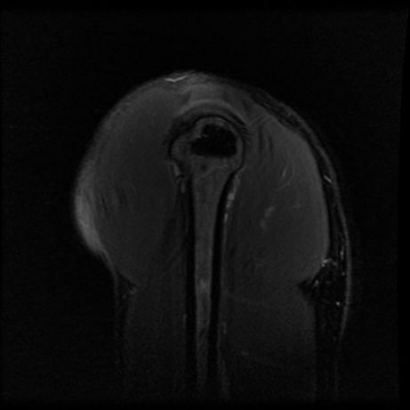 shoulder 2008