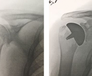 My own Price of the Platform- Shoulder Replacement
