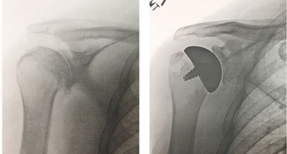 My own Price of the Platform- Shoulder Replacement