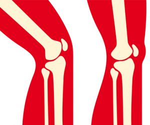 The Post-Surgical Knee: The Range of Motion Rebuild