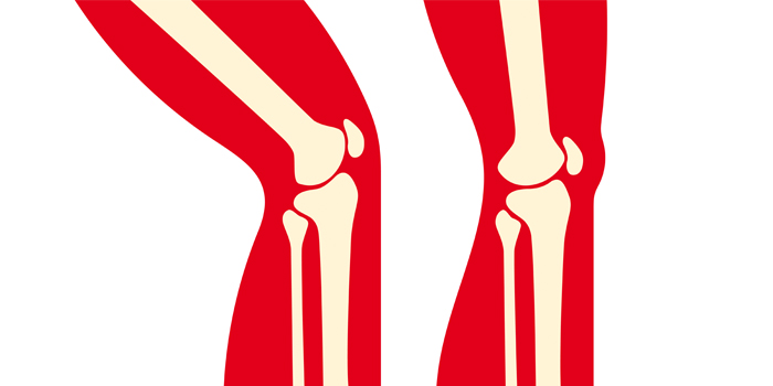 The Post-Surgical Knee: The Range of Motion Rebuild