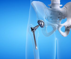 A Meathead’s Guide to Hip Replacement