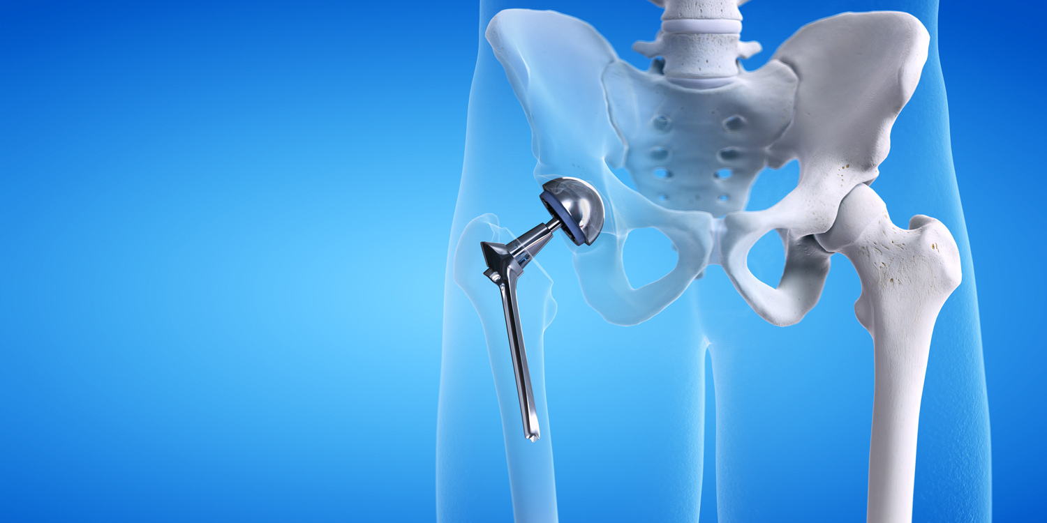 A Meathead’s Guide to Hip Replacement